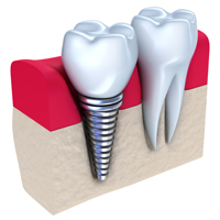 dental-implant-cross-section